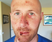 Recovering from a nasty MTB crash – Andrew Sloan